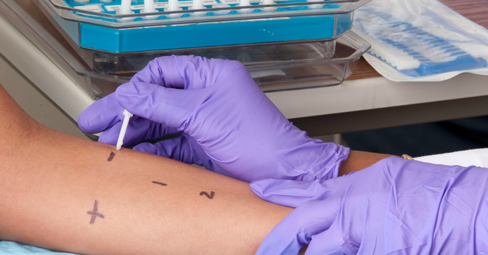 Skin Prick Testing Skin Prick Testing